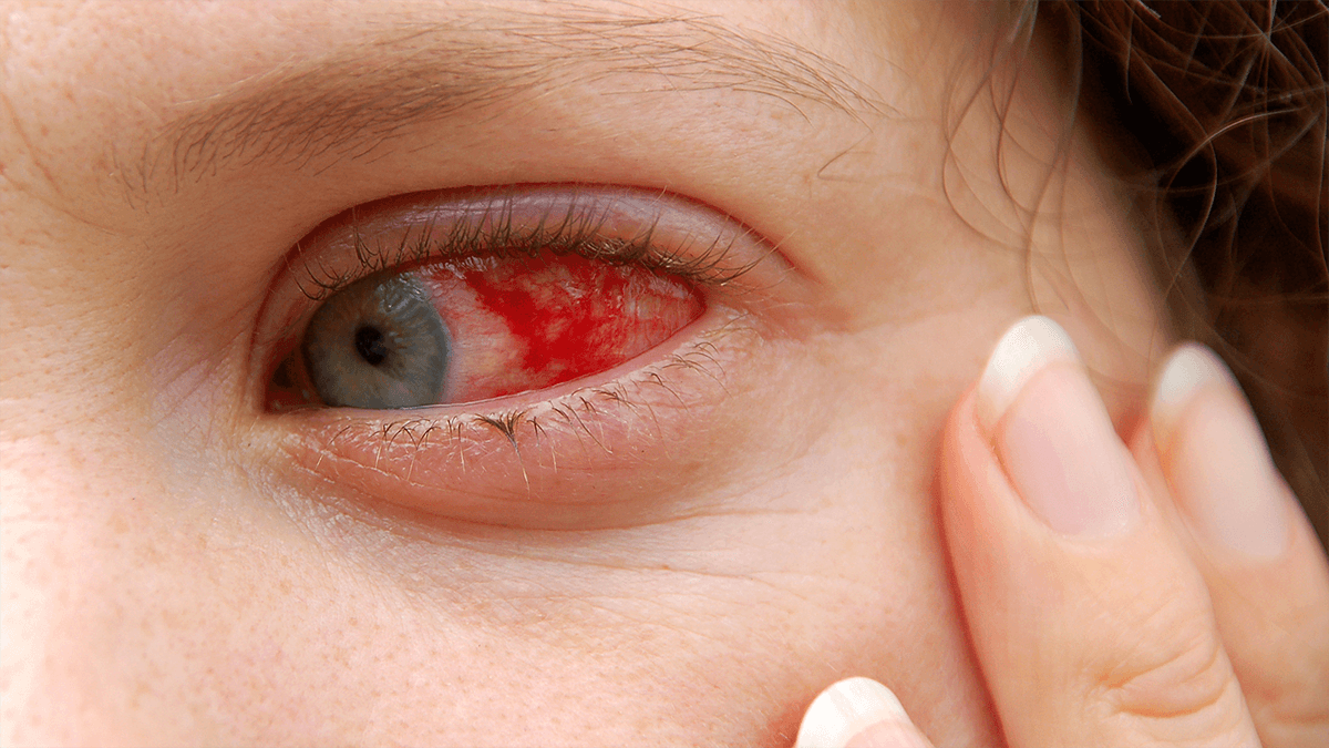 Pink eye, eye condition, eye health