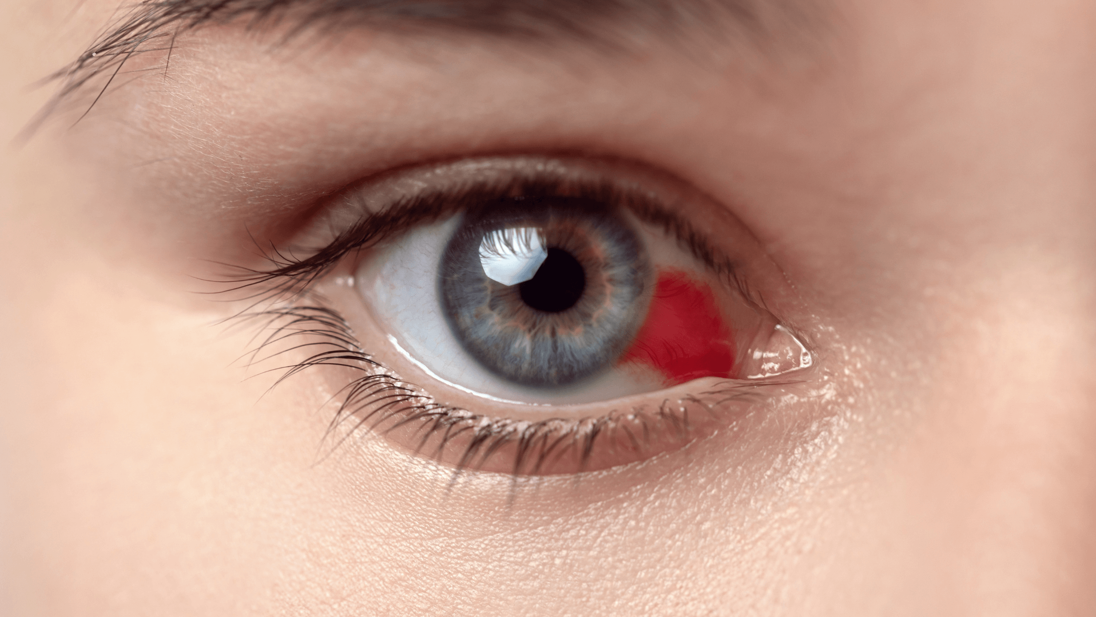 Bloodshot eye, eye care, eye condition