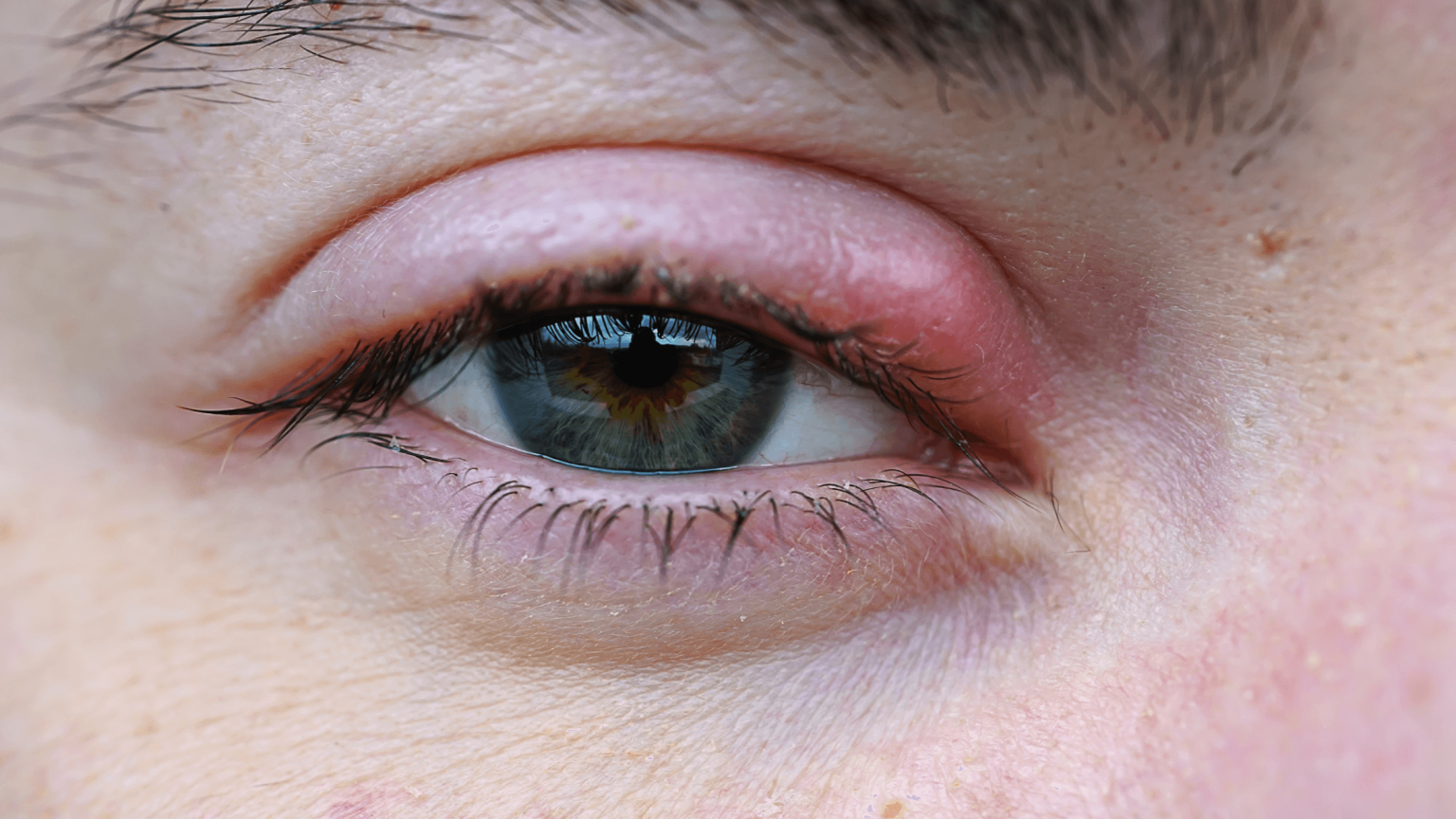 How to Recognize and Manage Common Eye Infections, Such as ...