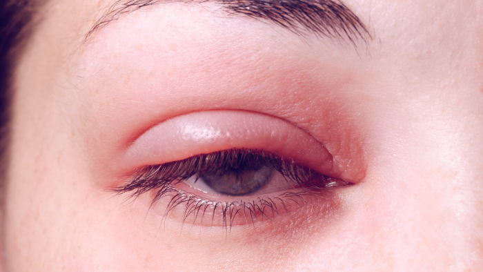 How To Recognize The Signs Of Common Eye Infections Total Eye Care 6502