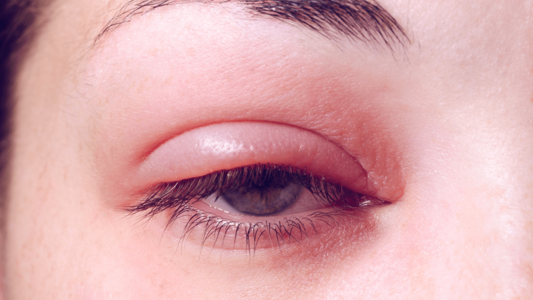 How to Recognize the Signs of Common Eye Infections - Total Eye Care