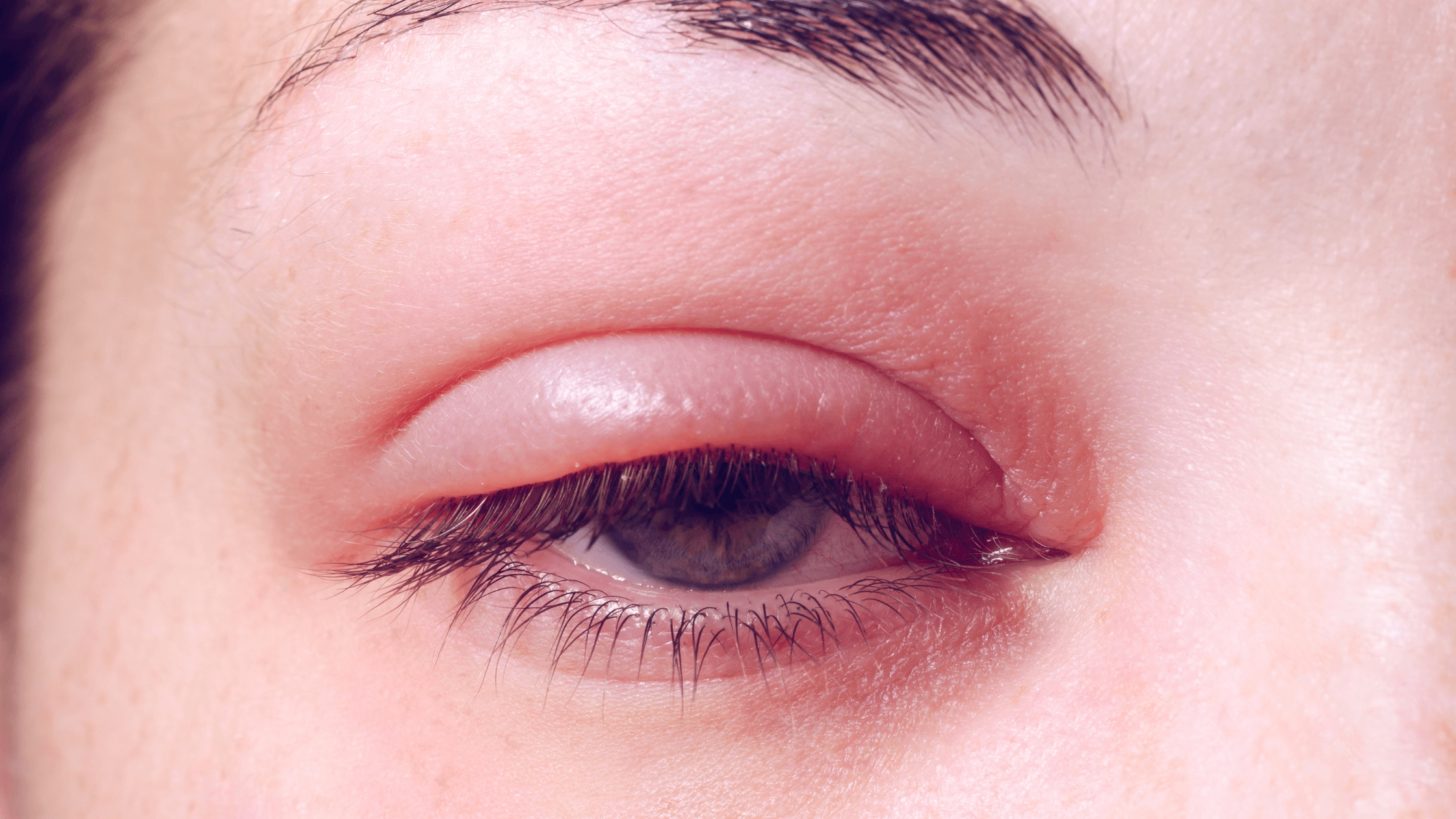 Eye infection, eye health, signs of common eye infections