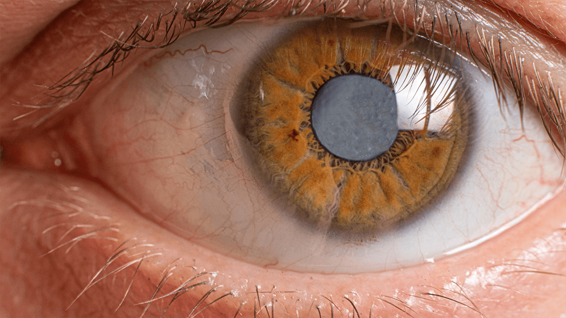 A close-up image of an eye affected by cataracts, showcasing the clouding of the lens and highlighting the importance of regular eye exams and professional treatment from an ophthalmologist to maintain eye health.
