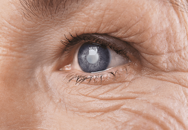 Eye of aging person showing signs of cataracts in eyes