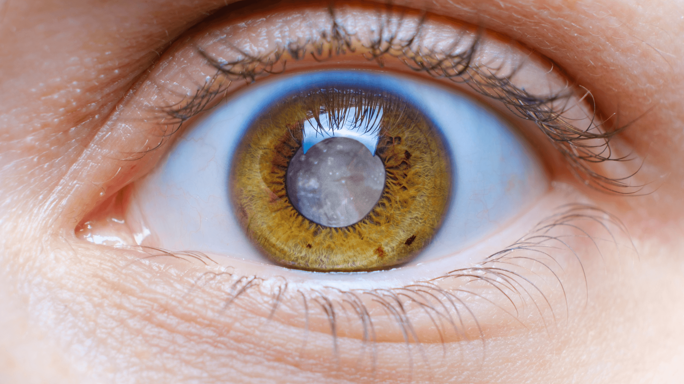 Detailed view of a cloudy eye lens, showing a cataract, for eye exam and cataract evaluation